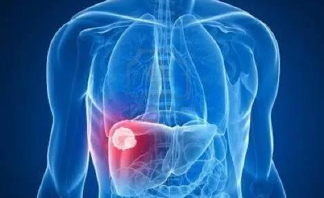 FDA批准Keytruda（pembrolizumab）用于完全切除后伴有淋巴结转移的黑色素瘤患者的辅助治疗