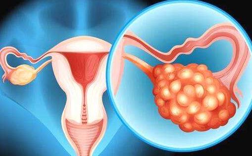 欧洲肿瘤学会：卵巢癌患者受益于联合靶向治疗