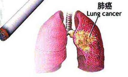 电子烟会引起肺癌吗？