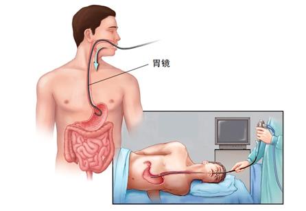 胃癌的诊断方式介绍