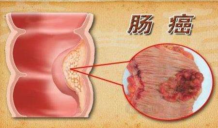 大肠癌的治疗方法