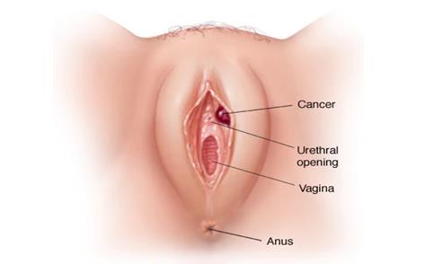 外阴癌的检查与诊断方法是什么