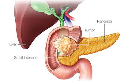 胰腺癌的治疗方式介绍