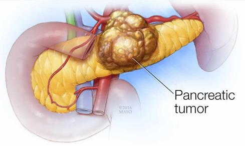 胰腺癌发生的原因及症状