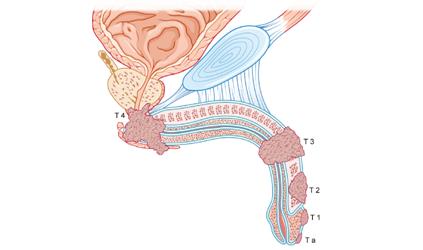 阴茎癌的检查、诊断与治疗方式介绍