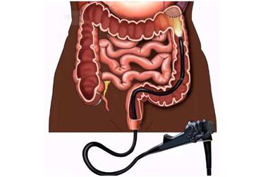 关于做肠镜检查的那些事儿