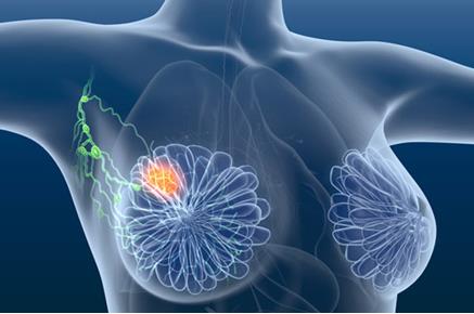 乳腺癌激素疗法可能只是让某些细胞“入睡”