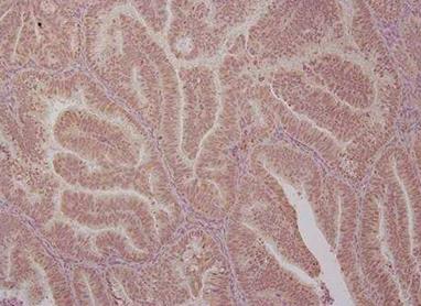 研究人员发现子宫内膜癌生长中的关键蛋白