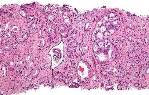 美国国家癌症研究所：新的联合活检方案可改善前列腺癌的诊断