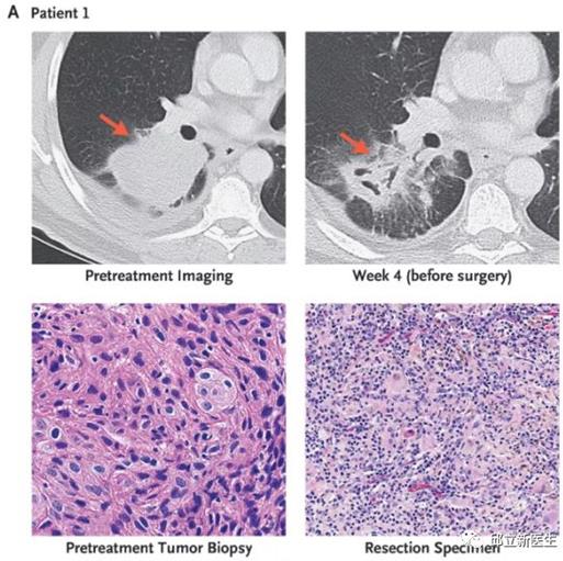 新辅助免疫治疗：打破传统新辅助治疗模式，患者术后获益飞升！