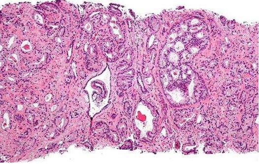 研究揭示了家族性前列腺癌的遗传起源
