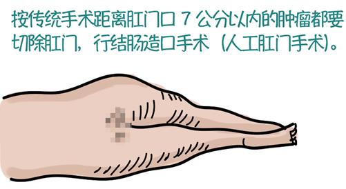 【科普】直肠癌患者宁死都要保肛？