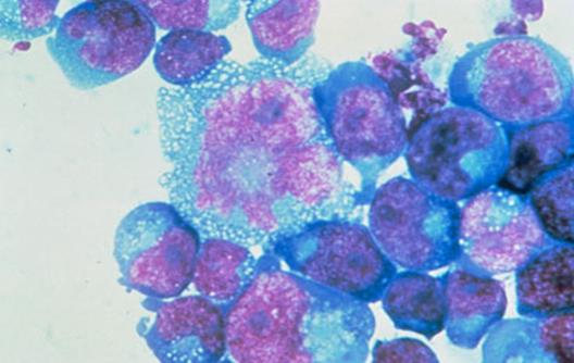 新型CAR-T细胞可以靶向白血病细胞多个位点