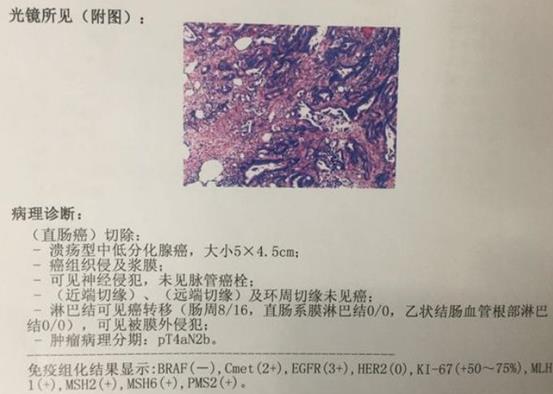 李心翔医生解析肠癌术后病理报告