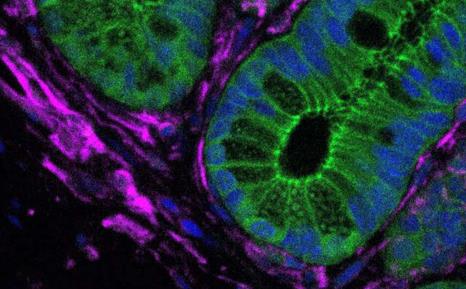 科学家怀疑细胞的邻居与引发大肠癌有重要关系