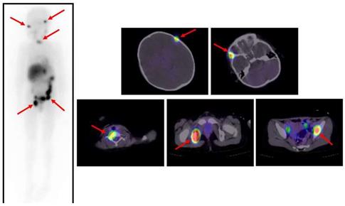 儿童神经母细胞瘤的新型放射性同位素疗法