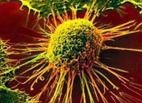 生物标志物测试可高度准确地检测早期肾癌