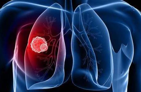 MET扩增EGFR阳性非小细胞肺癌监测ctDNA或可预测靶向药物疗效