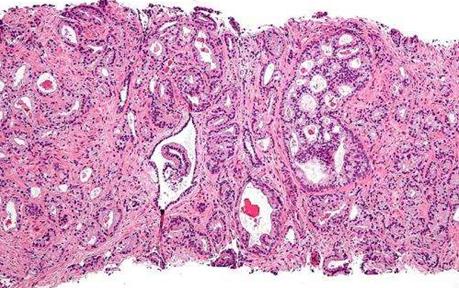 PARP抑制剂: 晚期前列腺癌的新治疗选择