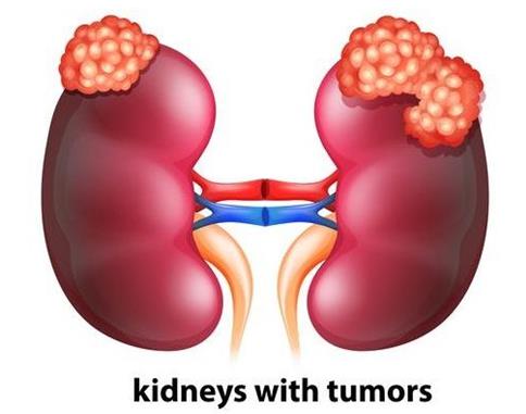 新的研究发现或将颠覆目前研究人员对肾细胞癌的认知