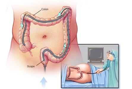 美国研究者发现：大肠癌高危患者缺乏结肠镜检查知识