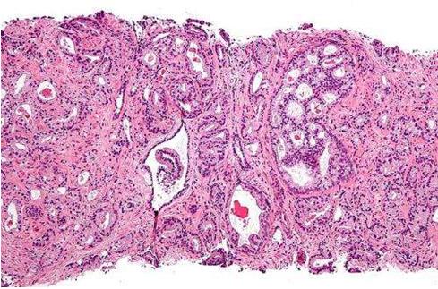 研究人员发现诊断转移性前列腺癌的新方法