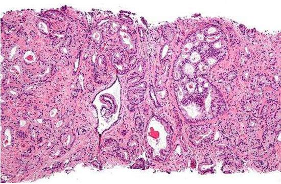 基因组差异可能是前列腺癌差异的关键