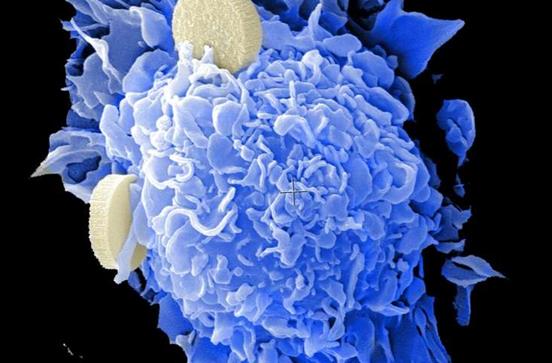 研究人员发现癌症转移和耐药性的驱动因子