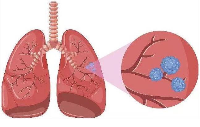 肺部结节是怎么形成的
