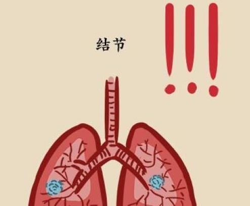 如何分辨肺结节的良恶性