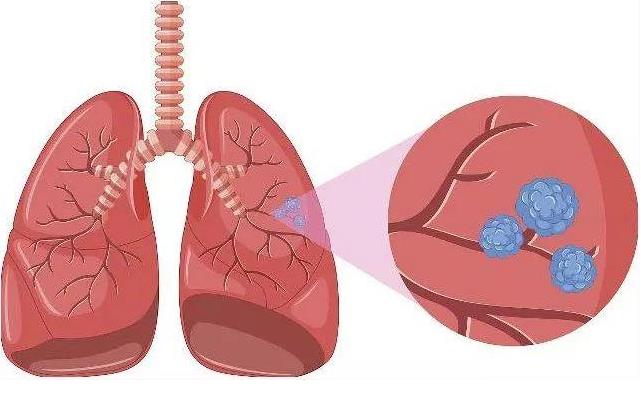 肿瘤指标筛查对肺结节诊断有多大的帮助
