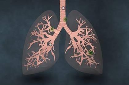 早期肺癌的外科分期方法