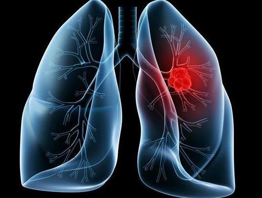 肺癌靶向治疗的发展历程