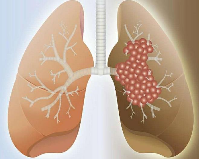 非小细胞肺癌靶向治疗