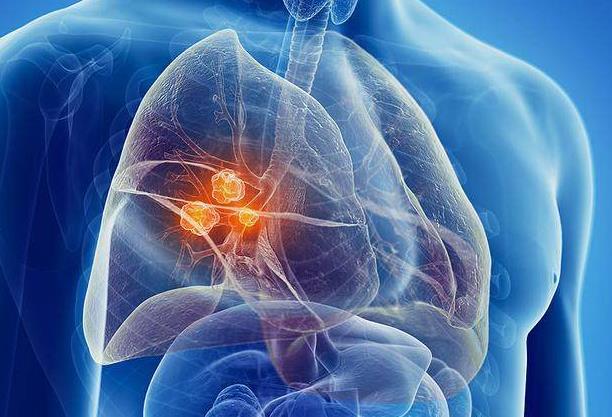 小细胞肺癌的分子靶向治疗