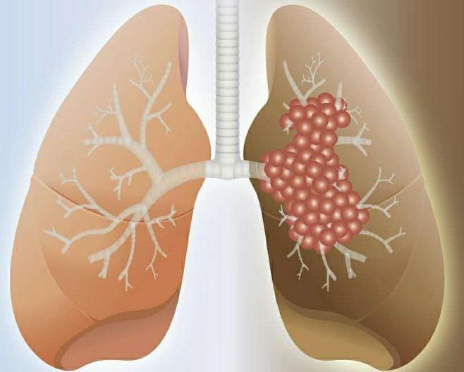 肺癌的基因治疗