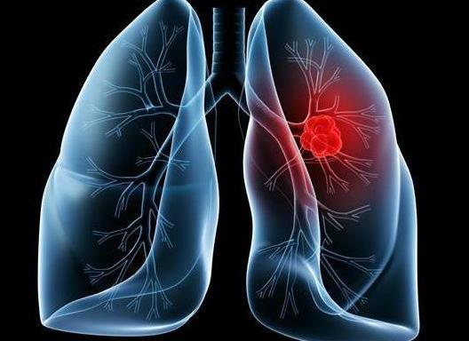 肺癌晚期出现腹水该怎么治疗？