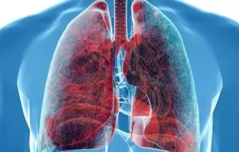 肺癌患者出现胸水腹水，多半是晚期，癌细胞已扩散！