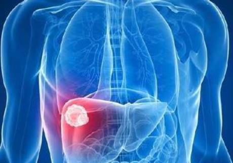 肝癌腹水症状的四个阶段