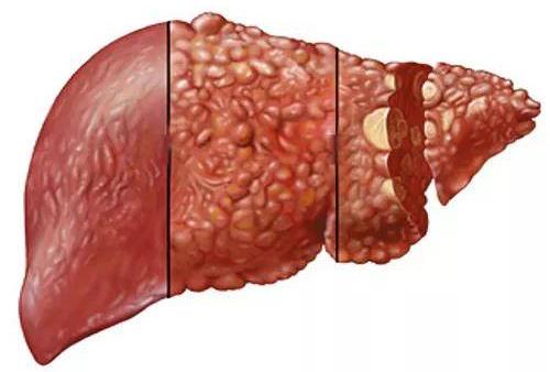 肝癌为什么前期没有反应，一旦检查出来就是晚期