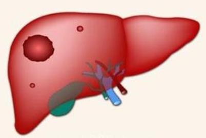 “腹胀不适”与“肝癌早期”：这些症状需警觉