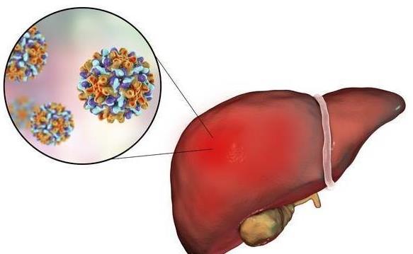 肝癌晚期并发肝腹水，是怎么回事