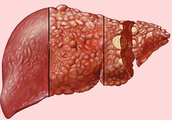 这5种身体反应可能是肝癌的早期症状