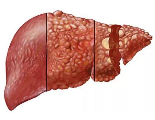 肝癌早期：请注意皮肤上的这些症状