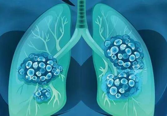 肺癌患者如何延长生存期