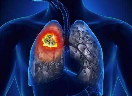 肺癌10大早期症状
