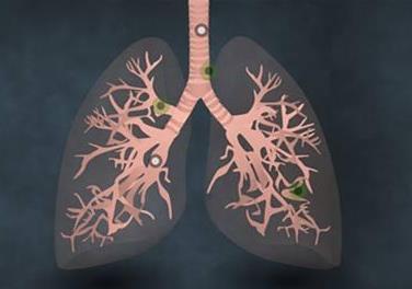 肺癌晚期临床症状表现