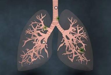 肺不好容易患肺癌，什么症状表明肺不好？