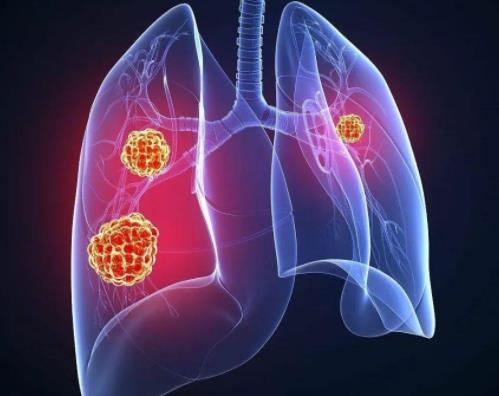 肺癌转移5大征兆