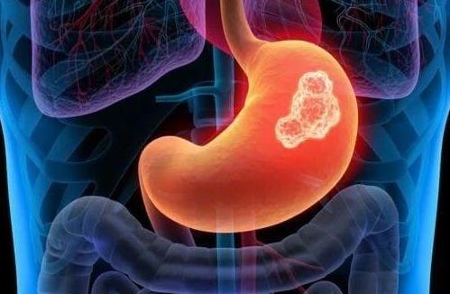 胃癌早期5大症状和4大诱因
